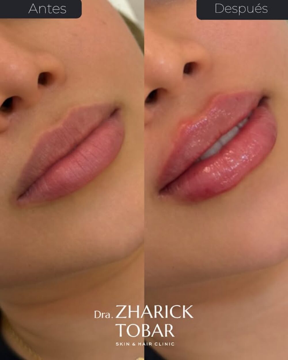 Antes y después de aumento de labios, vista de perfil