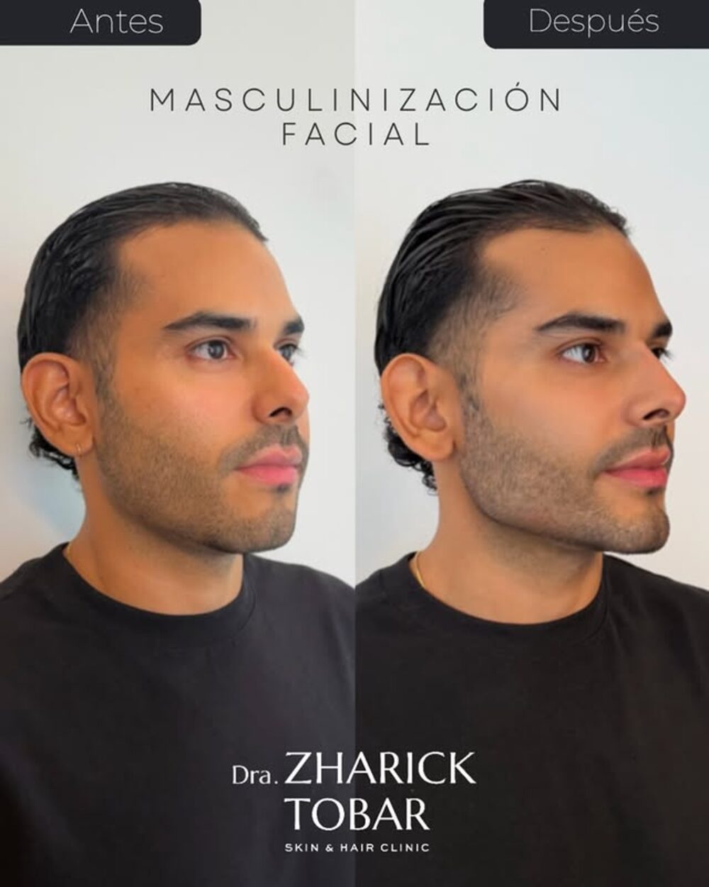 Antes y después de masculinización facial