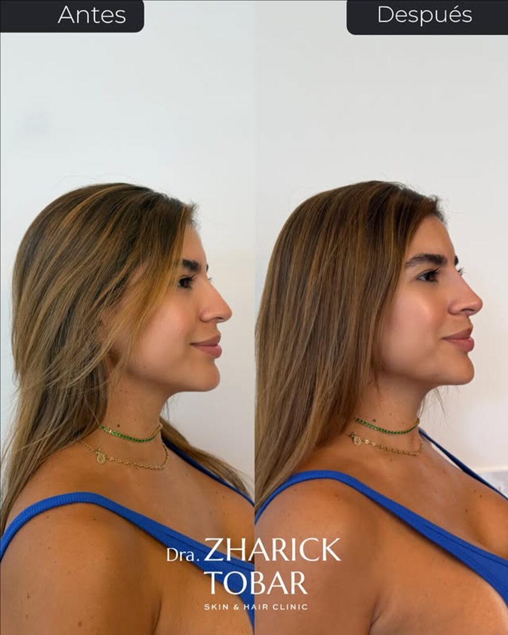 Antes y después de rinomodelación y armonía de perfil
