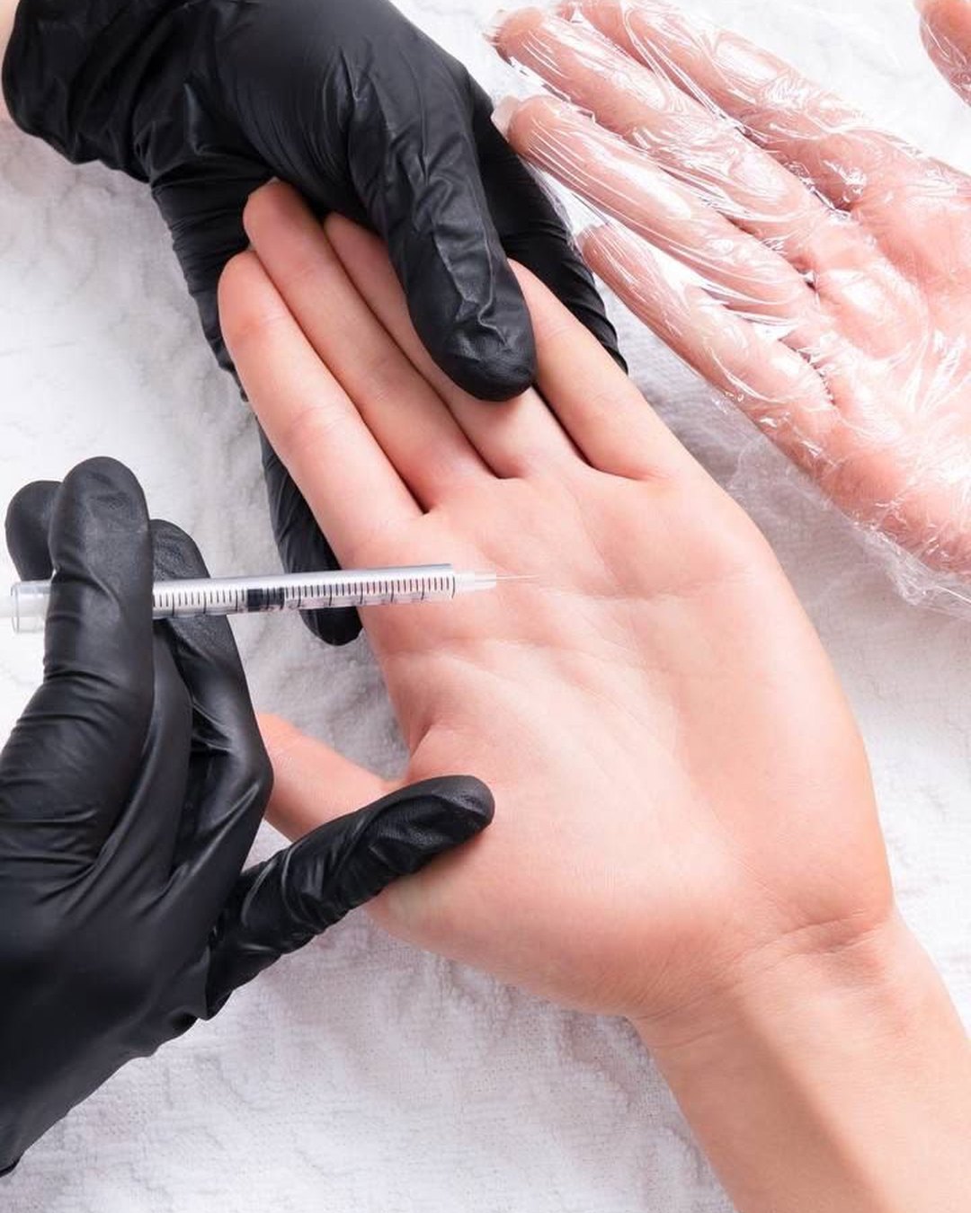 Tratamiento de hiperhidrosis palmar