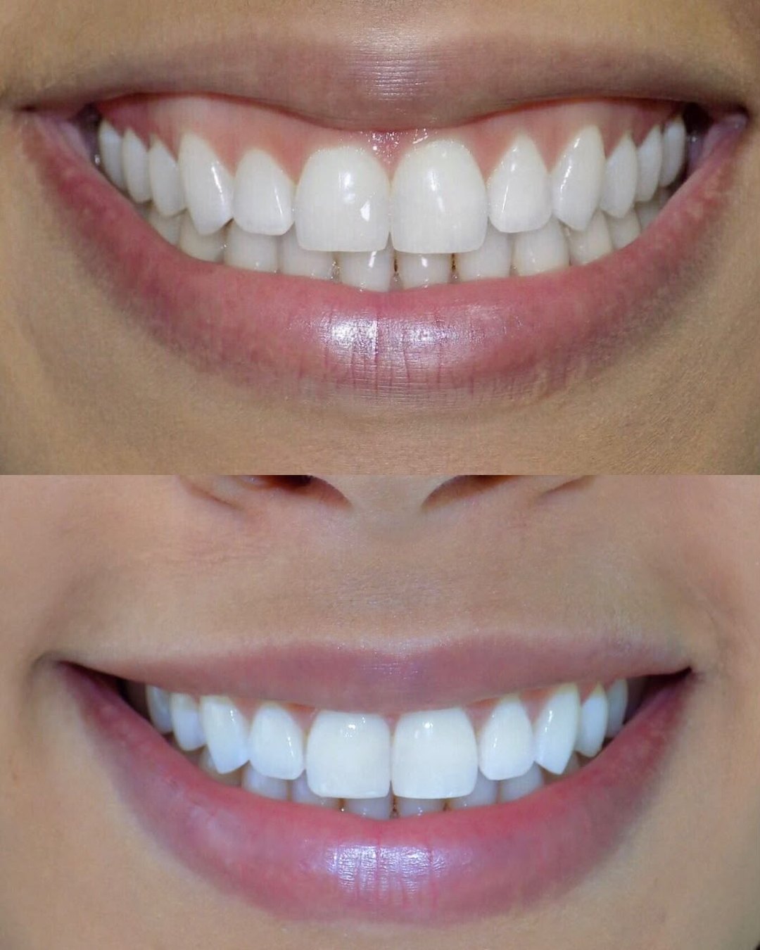 Resultado real · Sonrisa Gingival